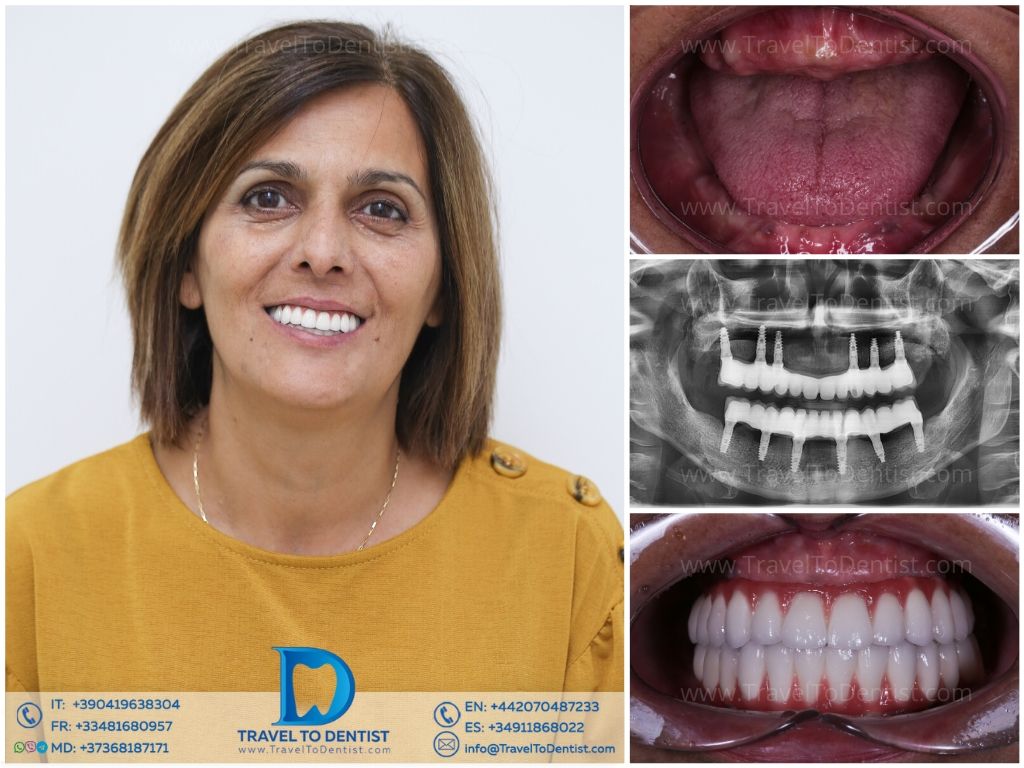 Caso clínico de paciente adulto con tratamiento de ortodoncia completo en Dental Carismas2
