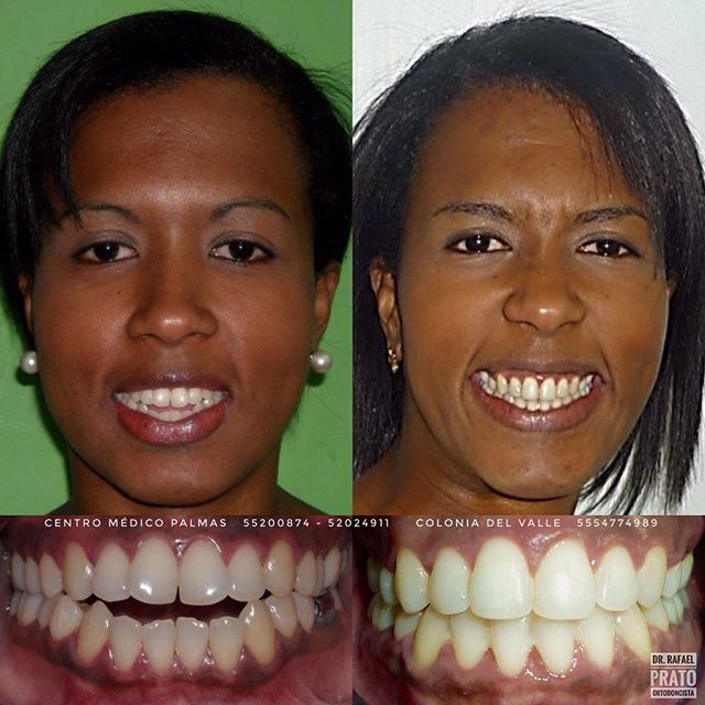 Resultado final de tratamiento dental con sonrisa brillante y alineada en Dental Carismas2