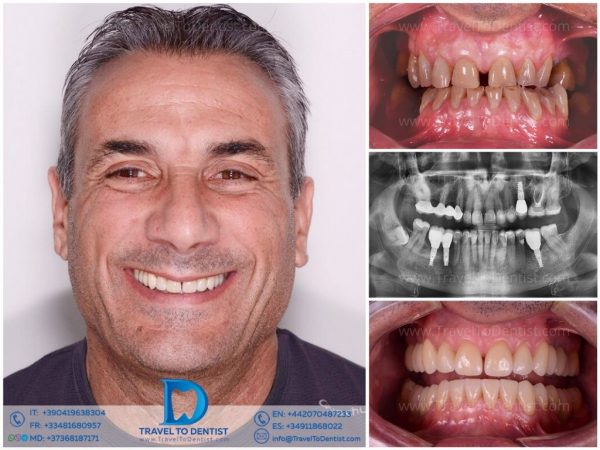 Resultado de tratamiento dental con sonrisa transformada en Dental Carismas2